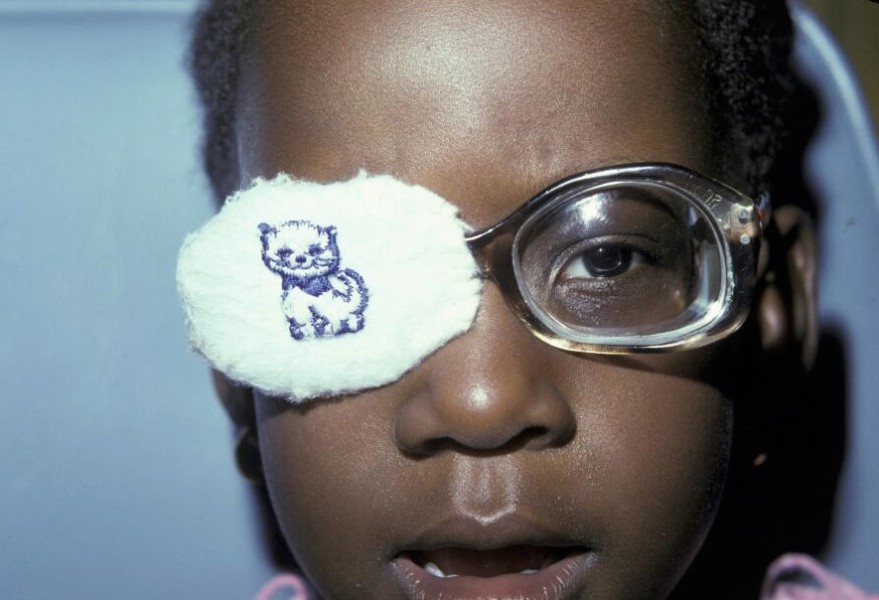 Young child getting eye surgery in the James H Hall Eye Center